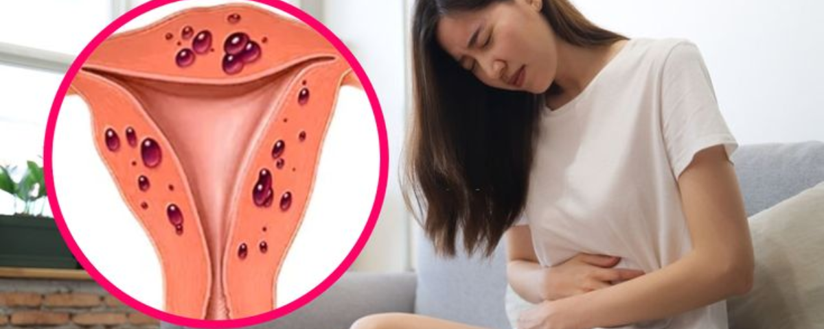 uterine fibroids